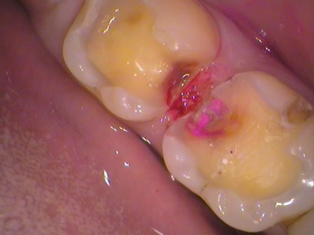 う蝕検知液で虫歯を染色