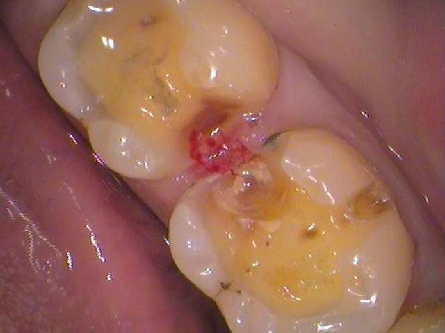 銀歯内部の虫歯