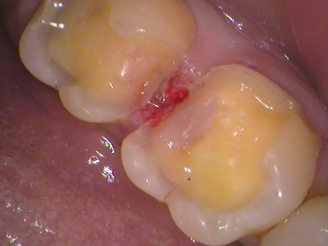 レジンでコーティング