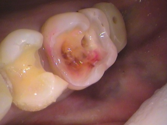 銀歯 虫歯 虫歯 セラミック