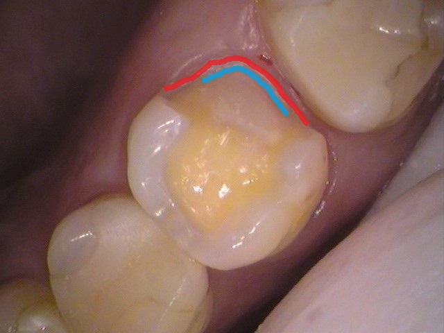 セラミックの虫歯