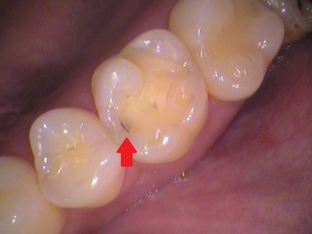 虫歯 セラミックインレー