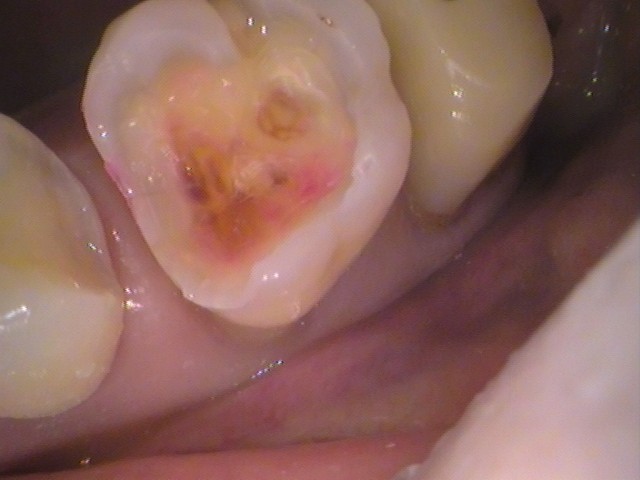 銀歯 虫歯 虫歯 セラミック