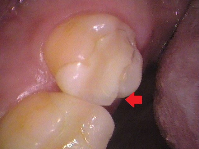 ハイブリッドからセラミック