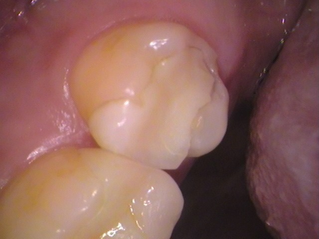 ハイブリッドからセラミック