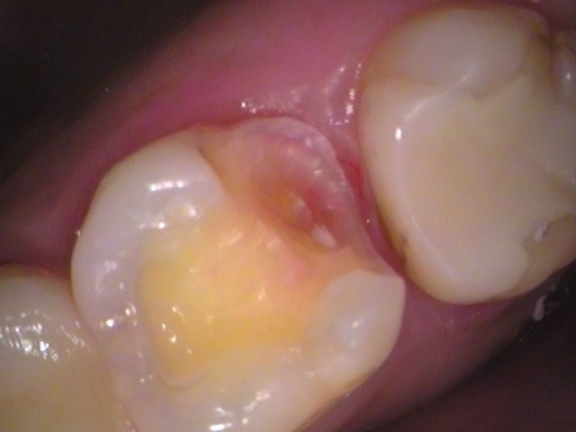 セラミックの虫歯