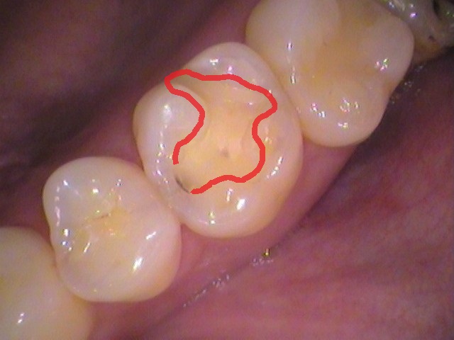 虫歯 セラミックインレー