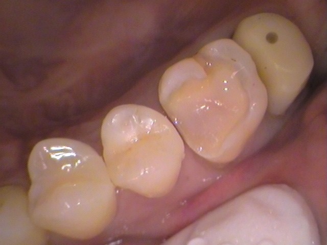 銀歯 虫歯 虫歯 セラミック