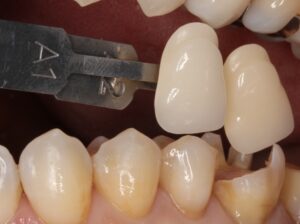 銀歯 虫歯 虫歯 セラミック