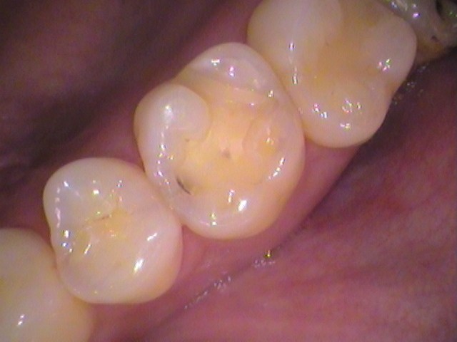 虫歯 セラミックインレー