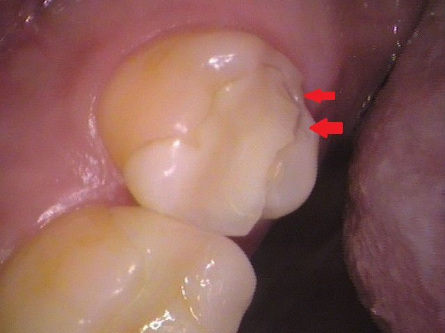 ハイブリッドからセラミック