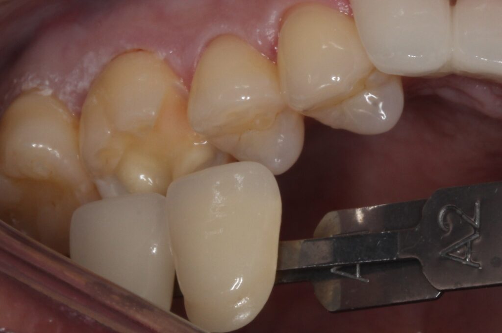 虫歯 セラミックインレー
