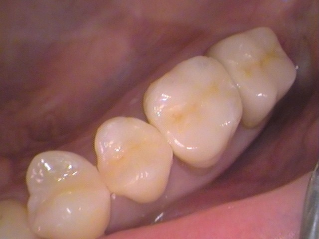 銀歯 虫歯 虫歯 セラミック