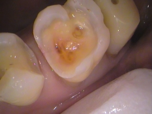 銀歯 虫歯 虫歯 セラミック