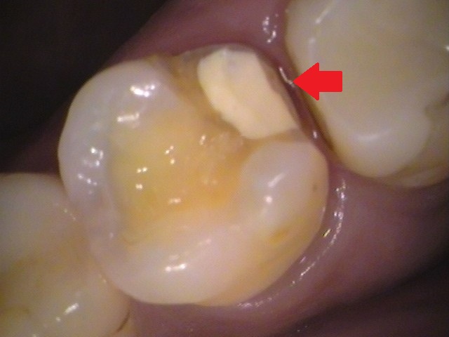 セラミックの虫歯
