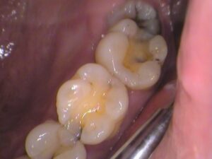 虫歯放置。親知らず。セラミック治療。