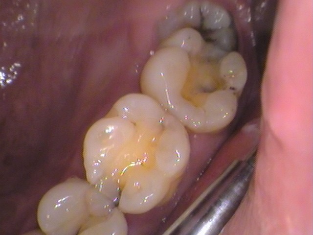 虫歯放置。親知らず。セラミック治療。