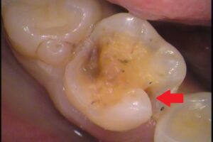 自由が丘　歯医者　虫歯　セラミックインレー