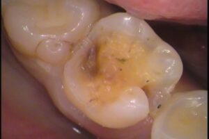 自由が丘　歯医者　虫歯　セラミックインレー