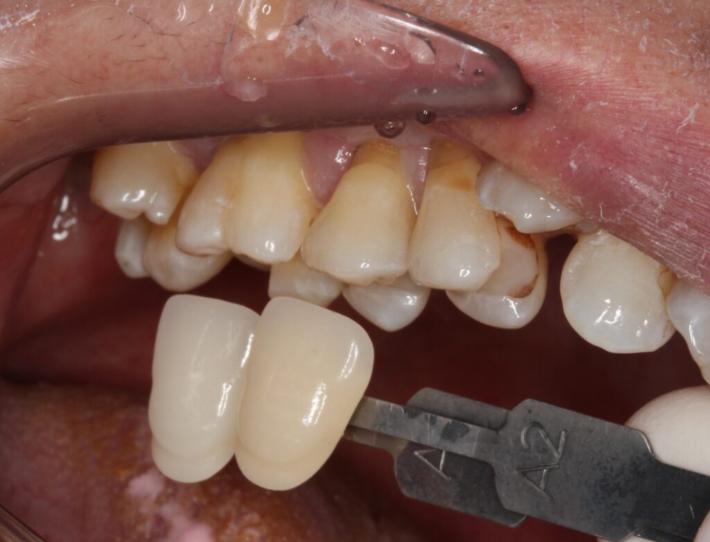 虫歯放置。親知らず。セラミック治療。