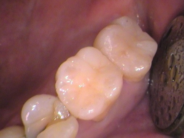 虫歯放置。親知らず。セラミック治療。