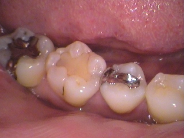 銀歯、虫歯、セラミック