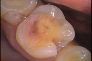 自由が丘　歯医者　虫歯　セラミックインレー