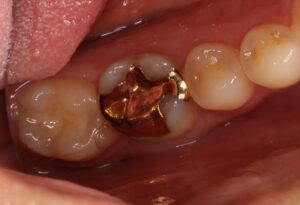 ゴールドインレー　自由が丘　歯医者　虫歯