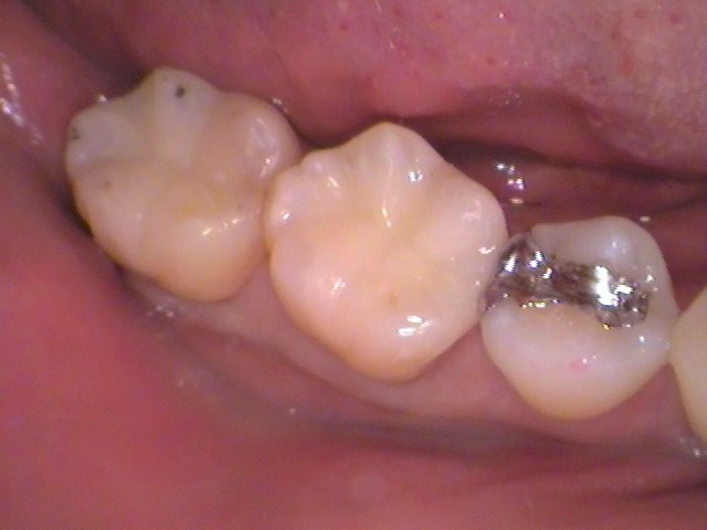 銀歯、虫歯、セラミック