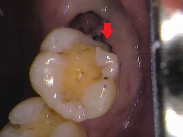 虫歯放置。親知らず。セラミック治療。