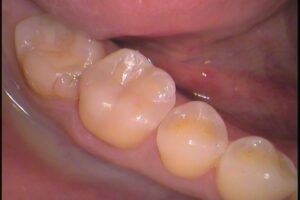 自由が丘　歯医者　ゴールド　セラミックインレー