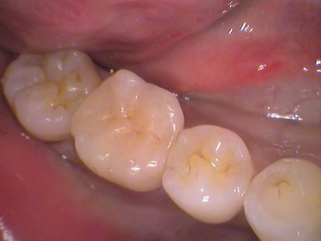 セラミックインレーセット