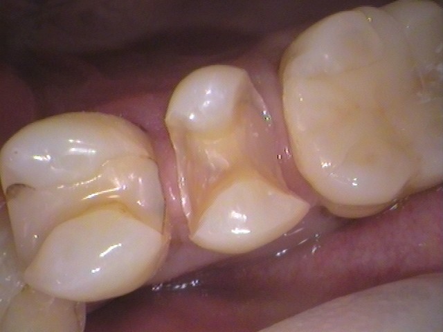 虫歯放置。親知らず。セラミック治療。
