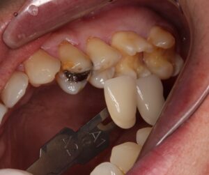 虫歯　セラミック治療　銀歯
