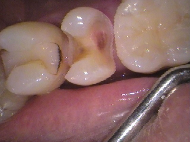 虫歯放置。親知らず。セラミック治療。