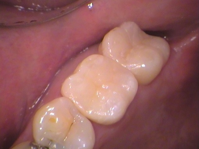 虫歯　セラミック治療　銀歯