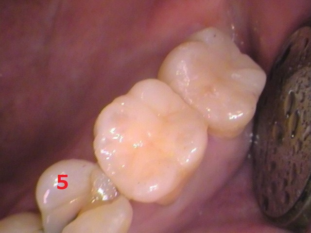 虫歯放置。親知らず。セラミック治療。