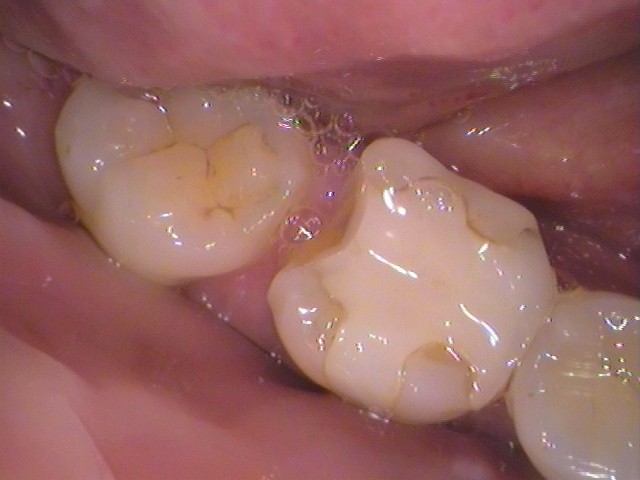 古いハイブリッドインレー