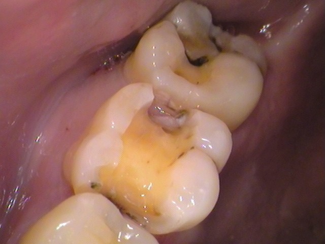 虫歯　セラミック治療　銀歯