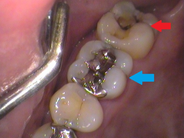 虫歯　セラミック治療　銀歯