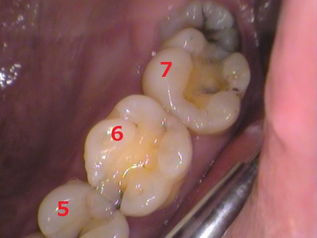虫歯放置。親知らず。セラミック治療。