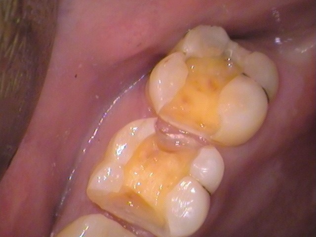 虫歯　セラミック治療　銀歯