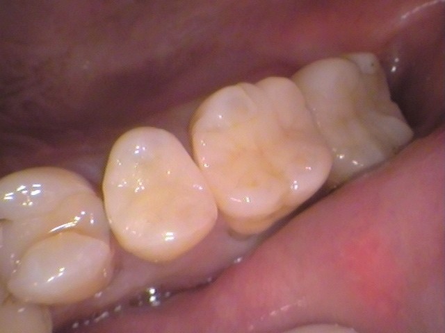 虫歯放置。親知らず。セラミック治療。