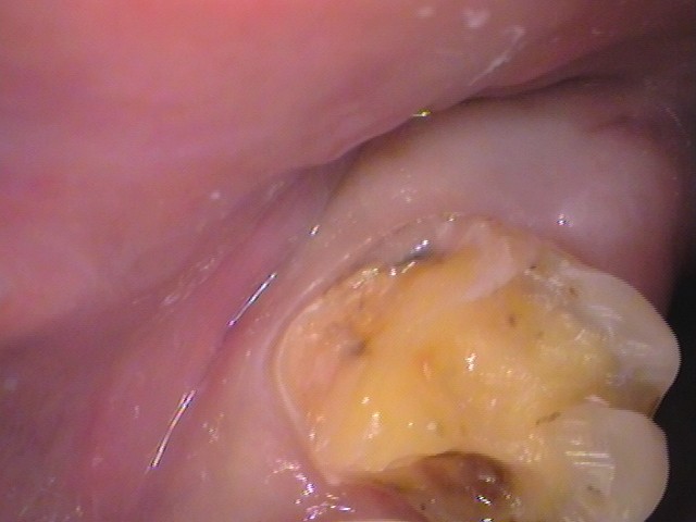 銀歯の中が虫歯　セラミック治療