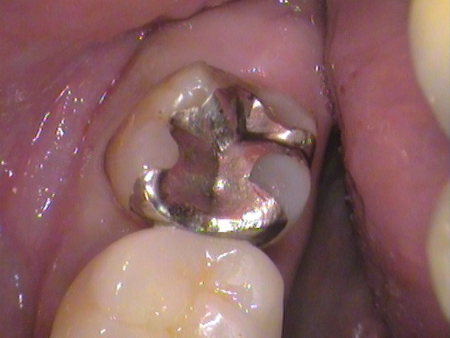 銀歯の中が虫歯　セラミック治療