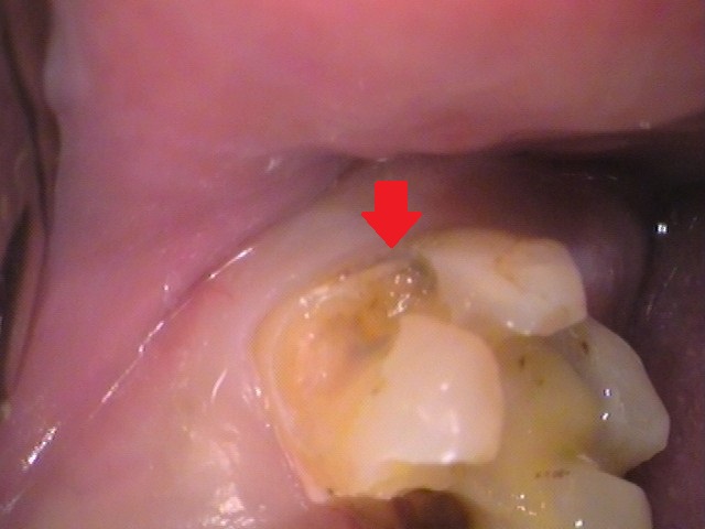 銀歯の中が虫歯　セラミック治療