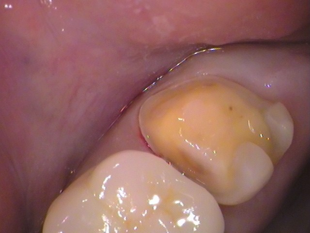銀歯の中が虫歯　セラミック治療