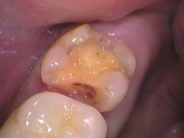 銀歯の中が虫歯　セラミック治療