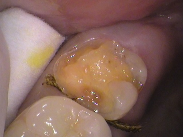 銀歯の中が虫歯　セラミック治療