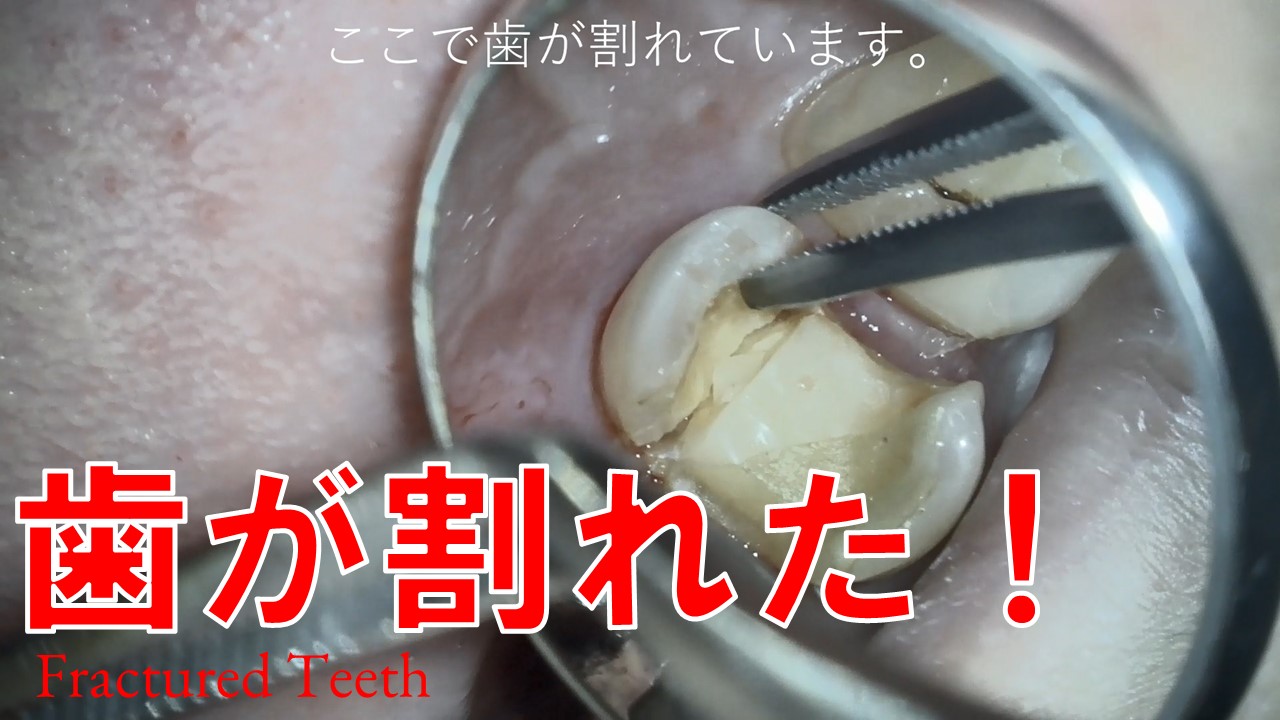 歯が割れた　歯根破折　歯のヒビ